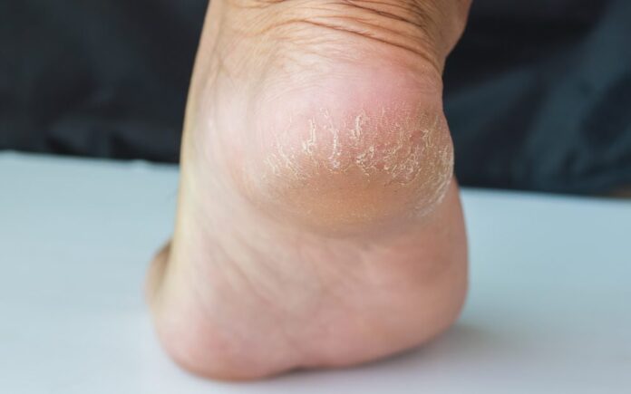 Ways To Treat Cracked Heels At Home